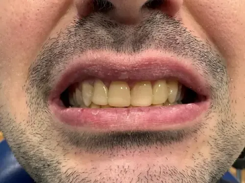 Después del tratamiento dental
