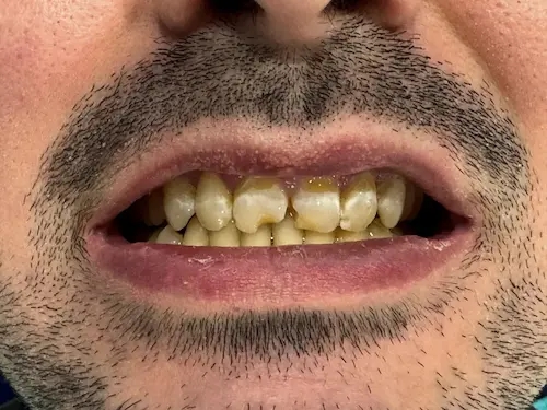 Antes del tratamiento dental