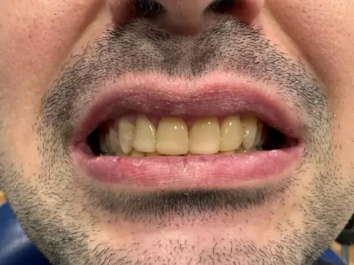 Después del tratamiento dental
