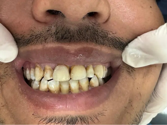 Antes del tratamiento dental