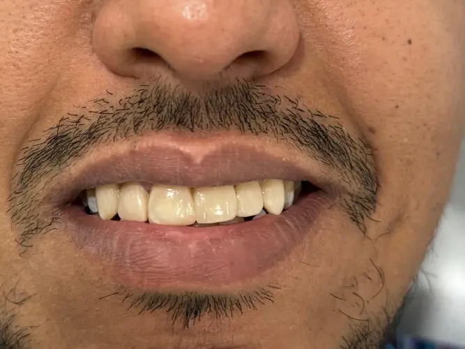 Después del tratamiento dental