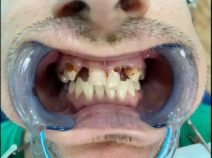 Antes del tratamiento dental