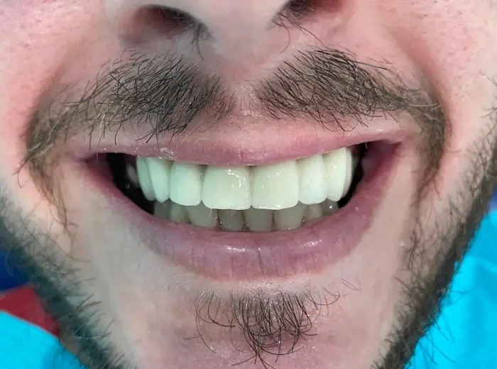 Después del tratamiento dental