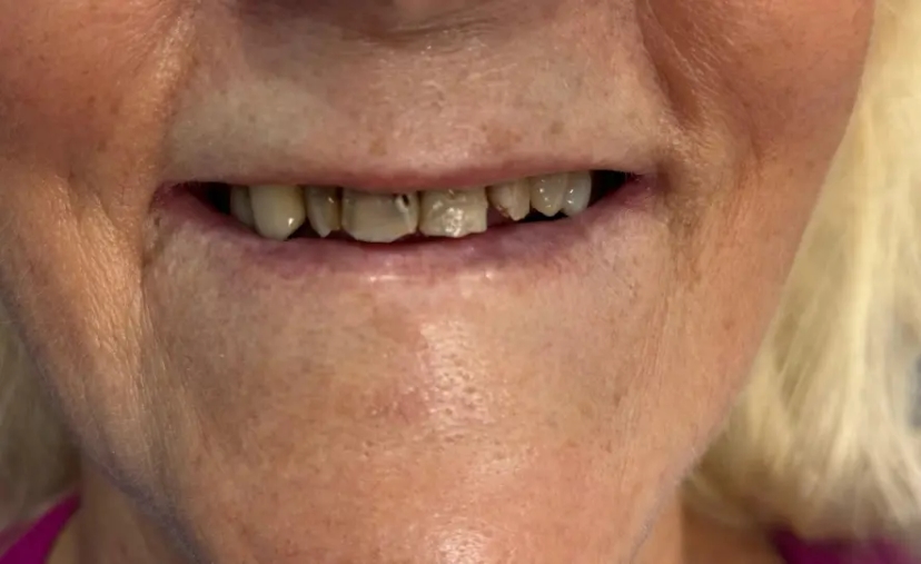 Antes del tratamiento dental
