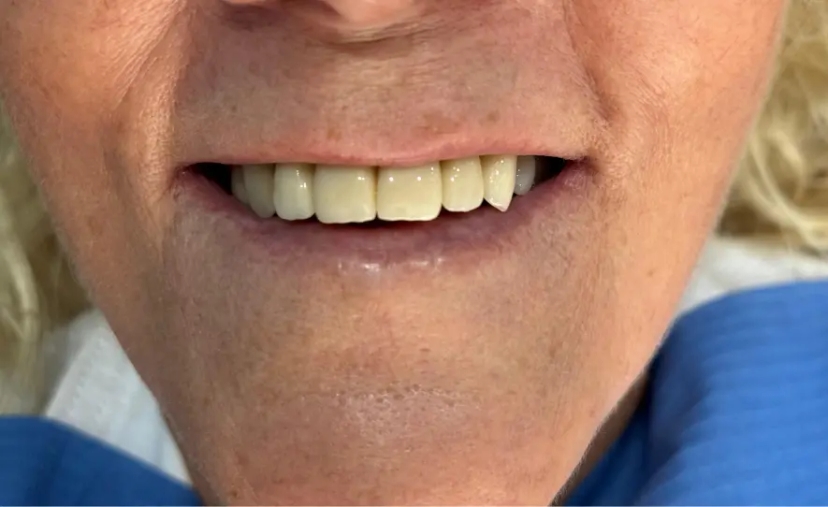 Después del tratamiento dental