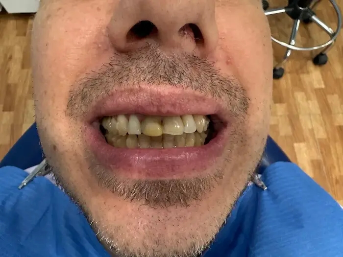 Antes del tratamiento dental