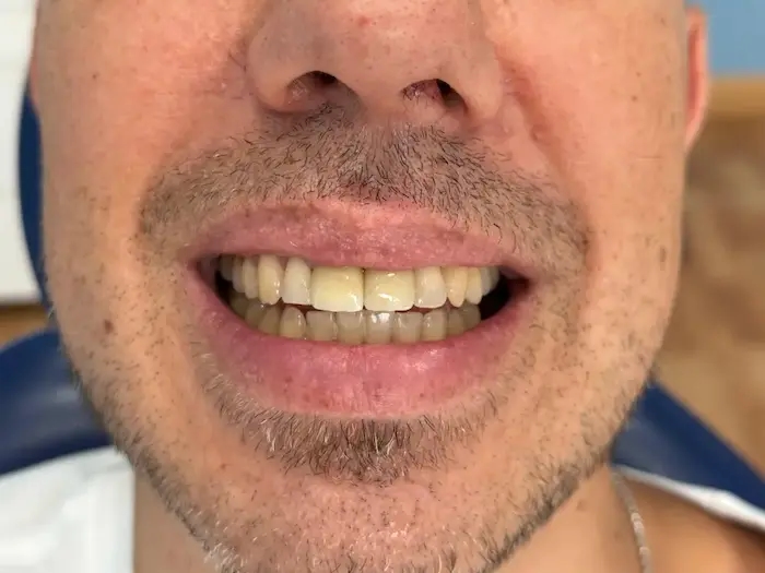 Después del tratamiento dental